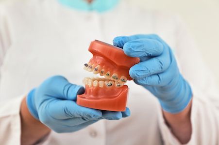 model of teeth with braces